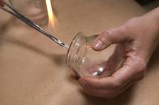 Cupping therapy