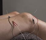 Electroacupuncture treatment