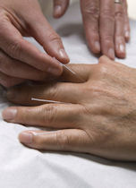 Acupuncture hand treatment